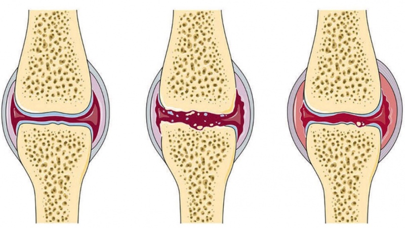 Noninvasive Therapy for Cartilage Regeneration - Tech Briefs