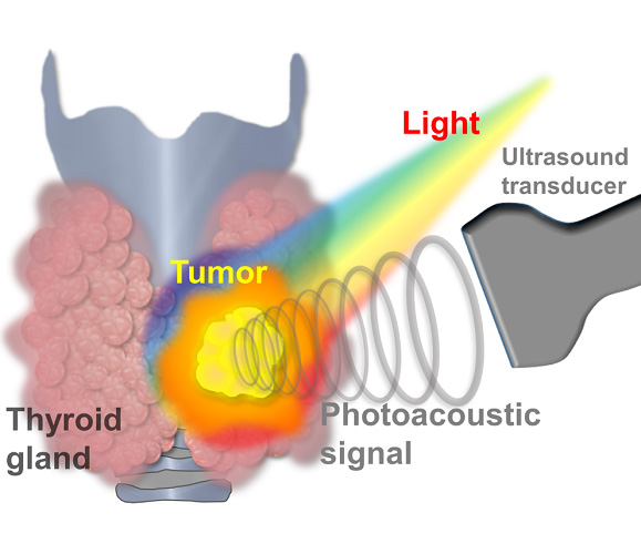 Cancer Diagram Image